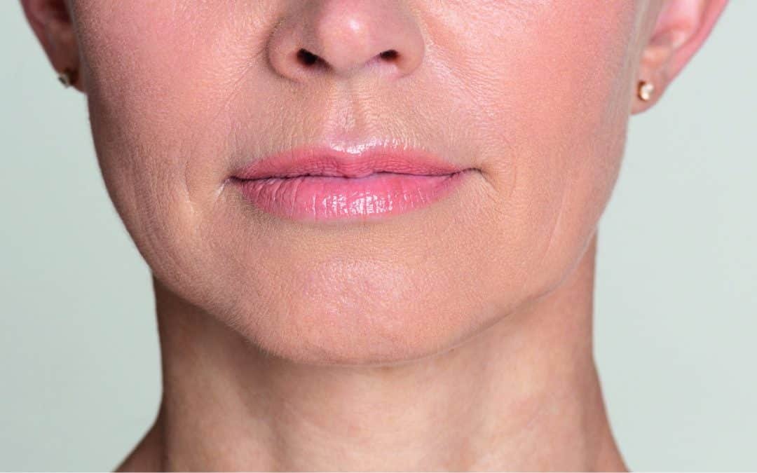 Rides de la bouche, quel traitement durable sans passer par la chirurgie ?