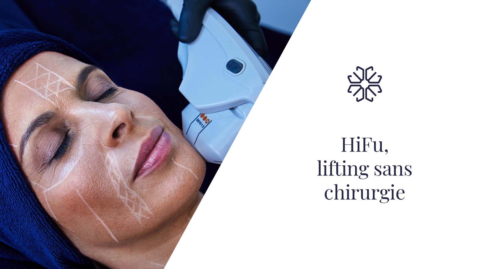 schéma profondeurs HIFU ultrasons focalisés SMAS lifting Antibes