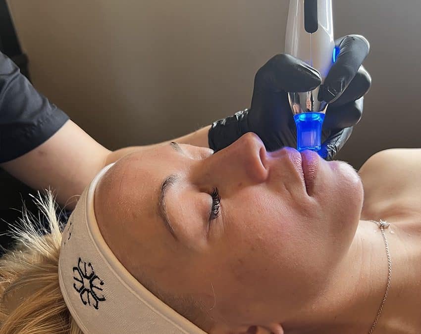 Microneedling: la solution parfaite pour une peau éclatante à Cannes