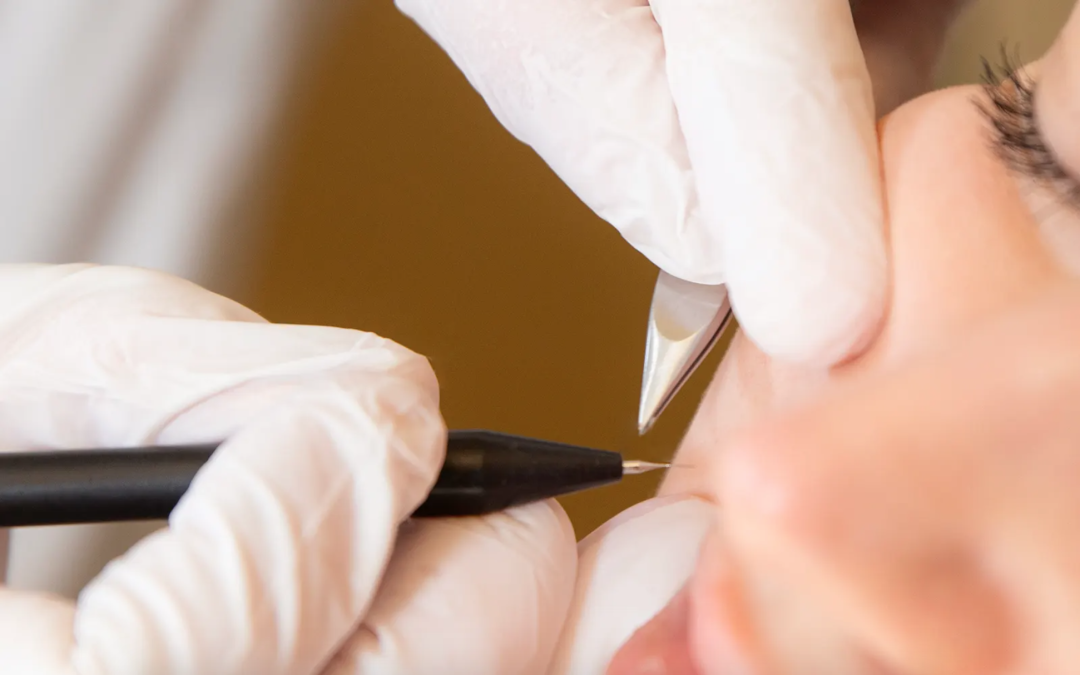 L&rsquo;Épilation définitive par l&rsquo;Électrolyse : Trouvez la solution idéale au Centre Thetys à Cannes