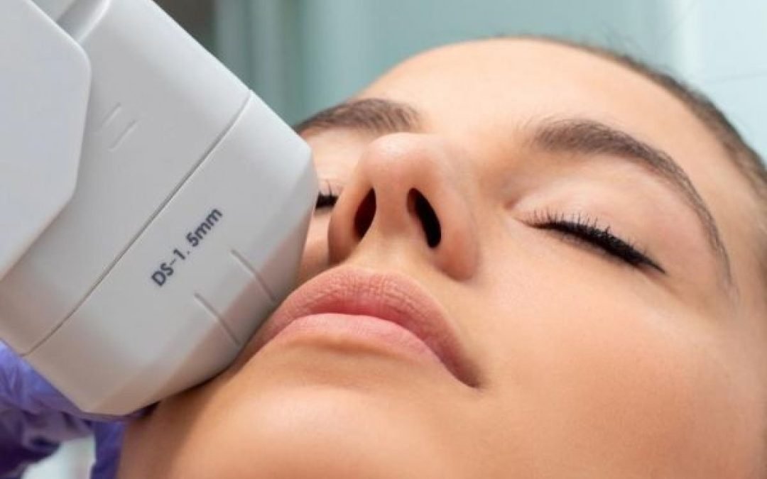 HIFU à Antibes : guide expert du lifting sans chirurgie par ultrasons focalisés