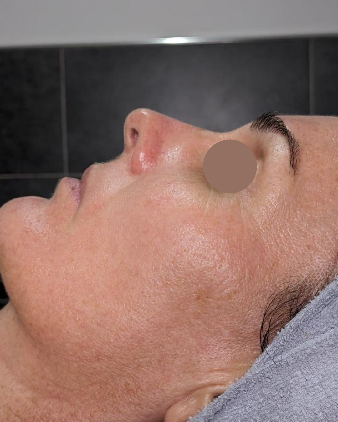 Traitement HIFU RF anti-âge au Centre Thetys