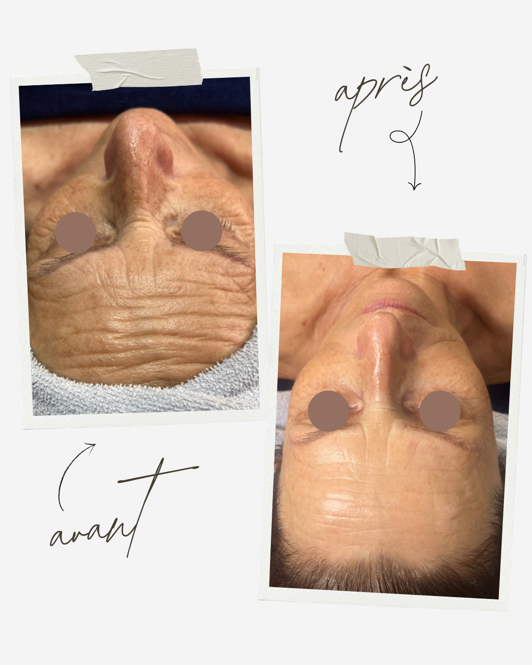 Résultat avant après traitement JetPeel - Centre Thetys Cannes Antibes