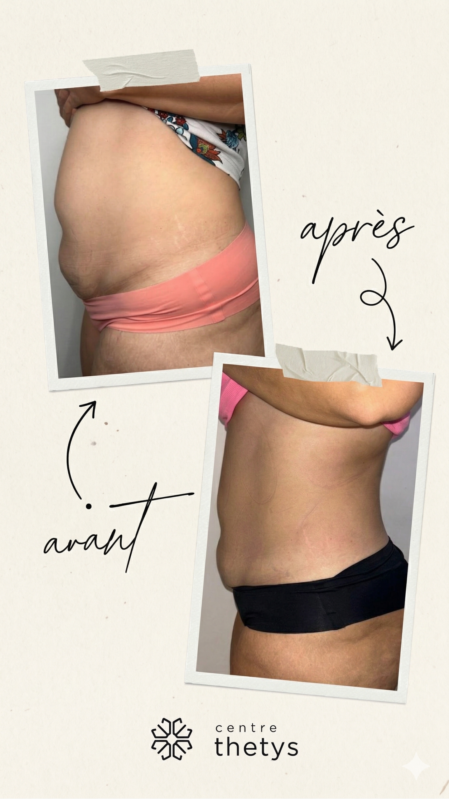 Résultat avant après cryolipolyse au Centre Thetys Antibes — remodelage corporel visible