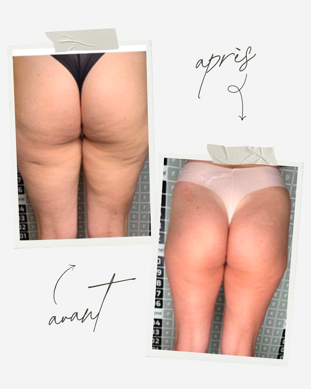 Avant Après traitement Icoone