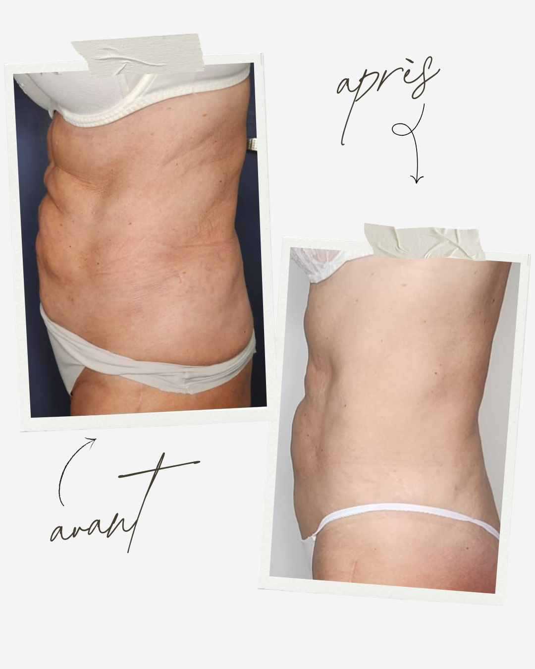 Avant Après traitement Icoone Laser