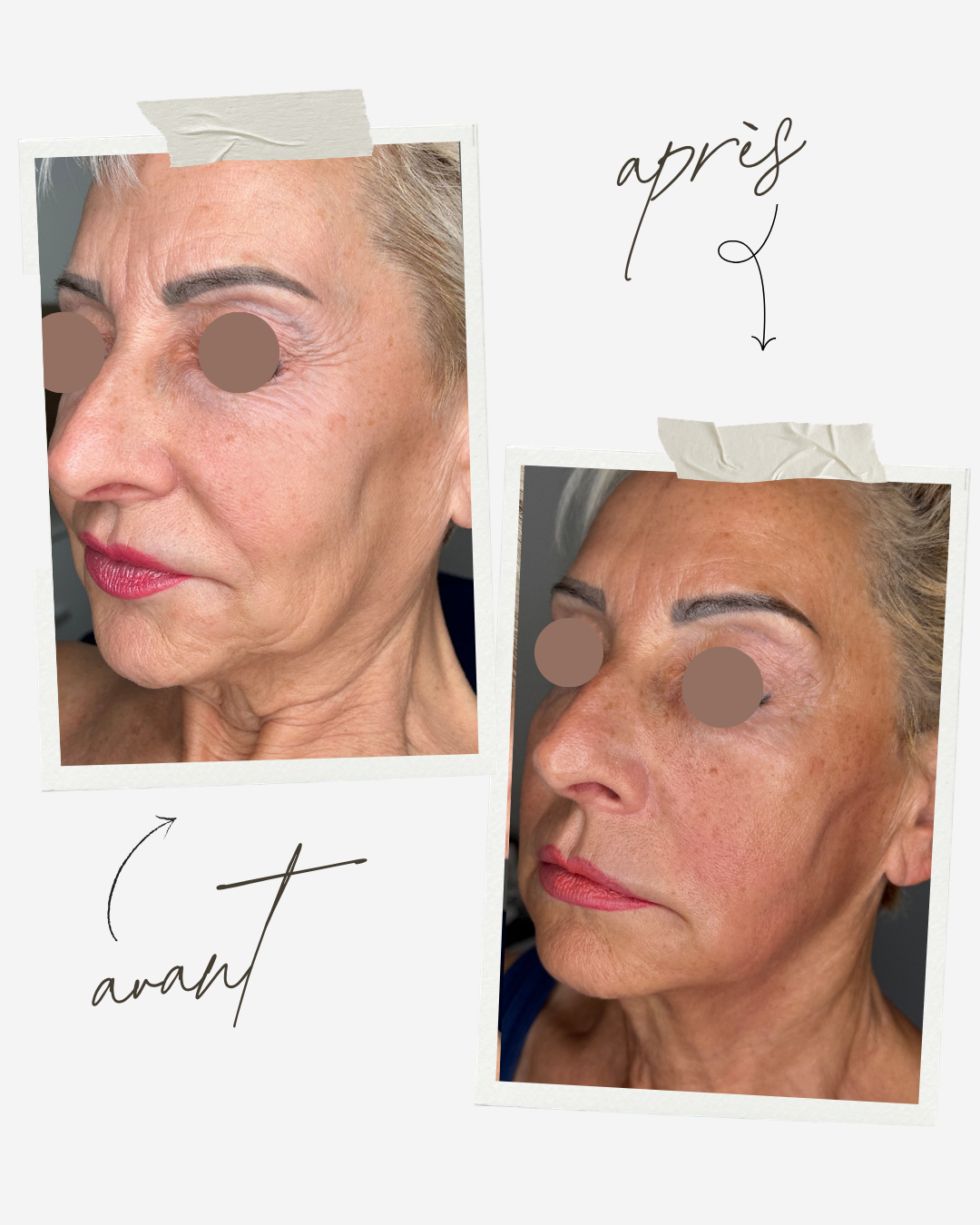 JetPeel à Antibes : le soin pour une peau éclatante sans aiguille ni injection 2 Résultat avant après soin JetPeel anti-rides Centre Thetys Antibes