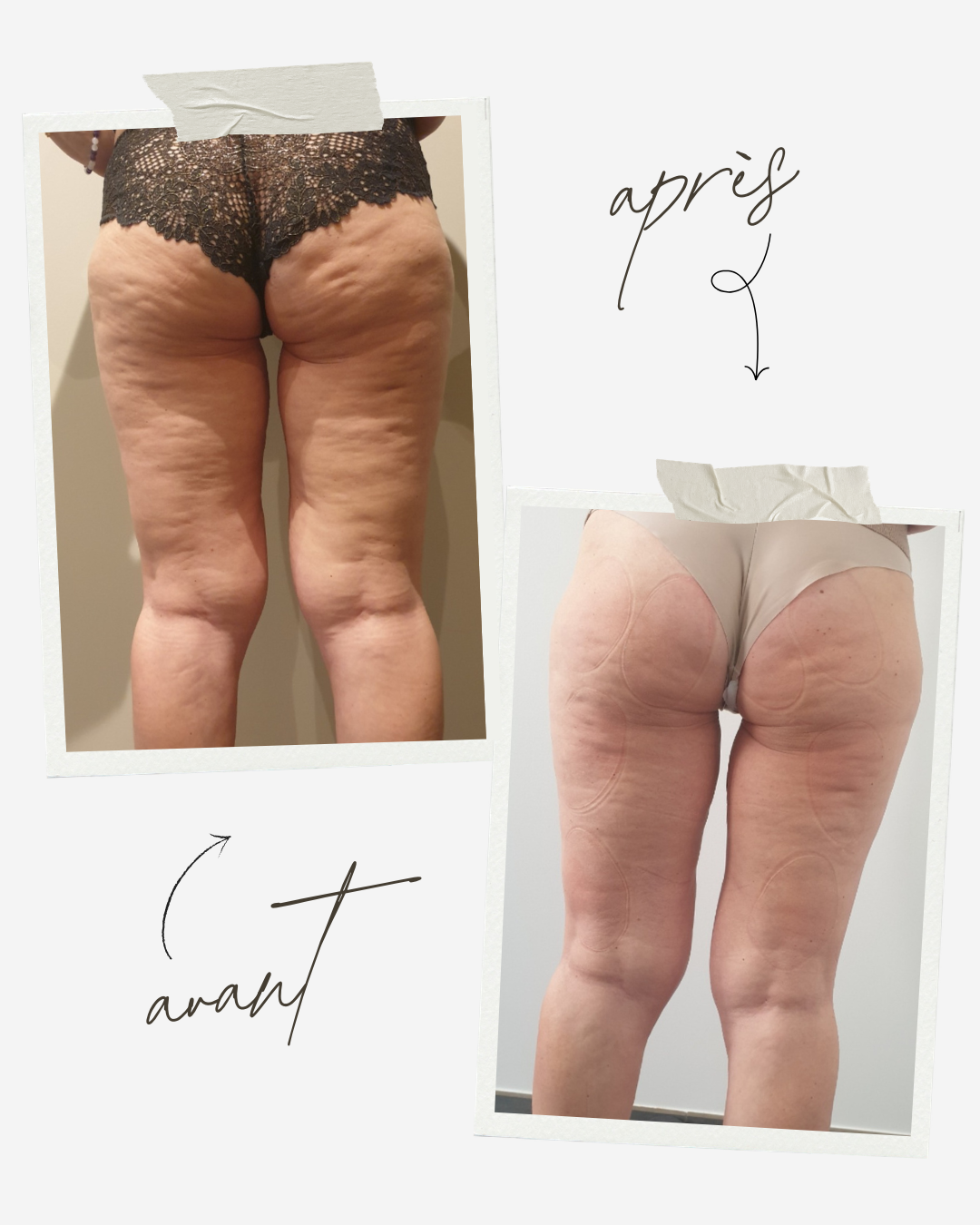 Avant Après traitement minceur Ipulse