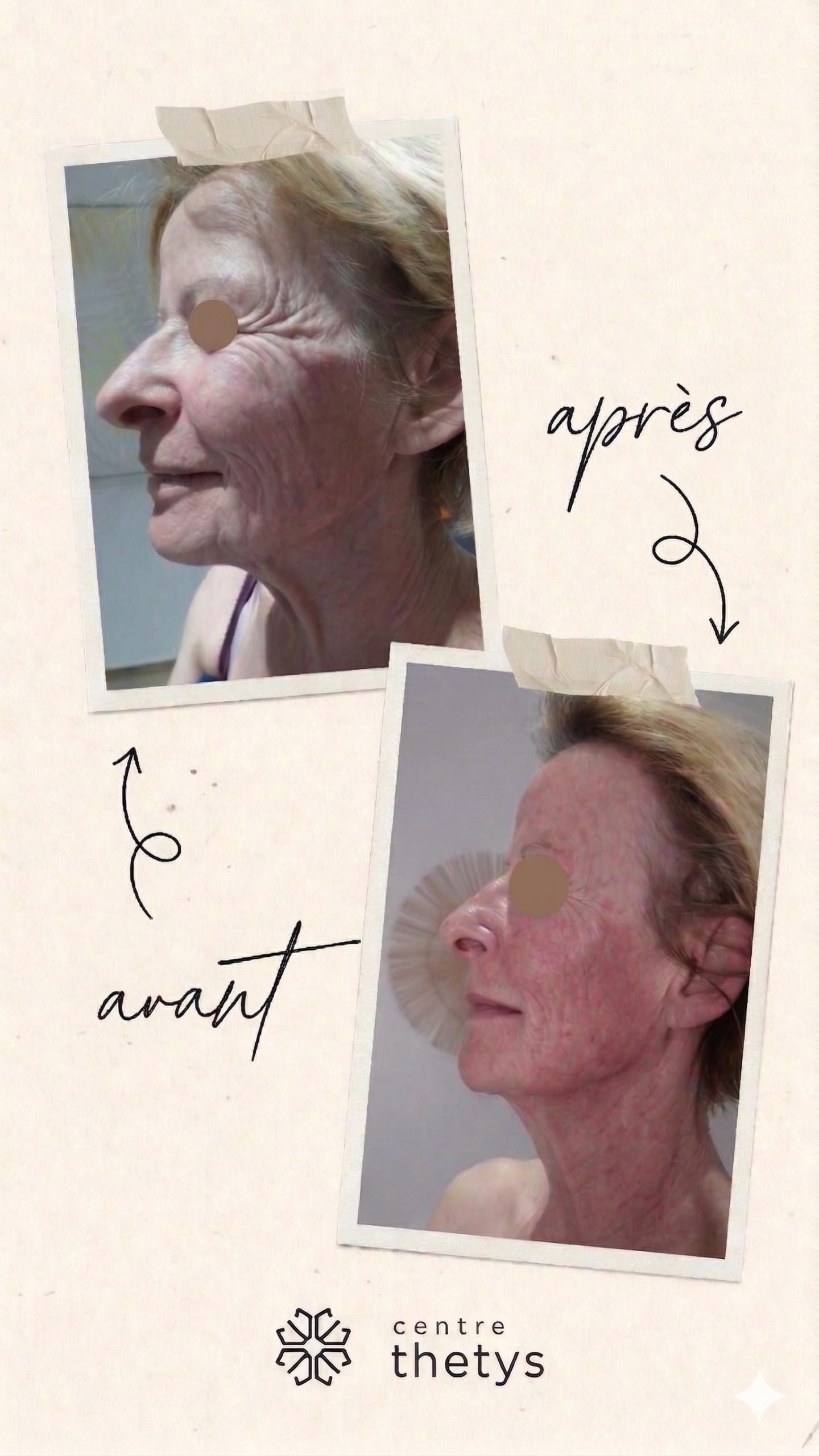 résultat HIFU lifting non chirurgical avant après Centre Thetys Antibes