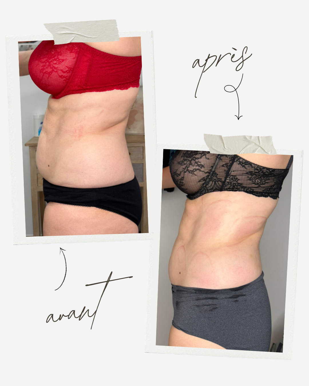 Avant / après IPULSE 5.1 Thalgo - résultats remodelage corporel Centre Thetys