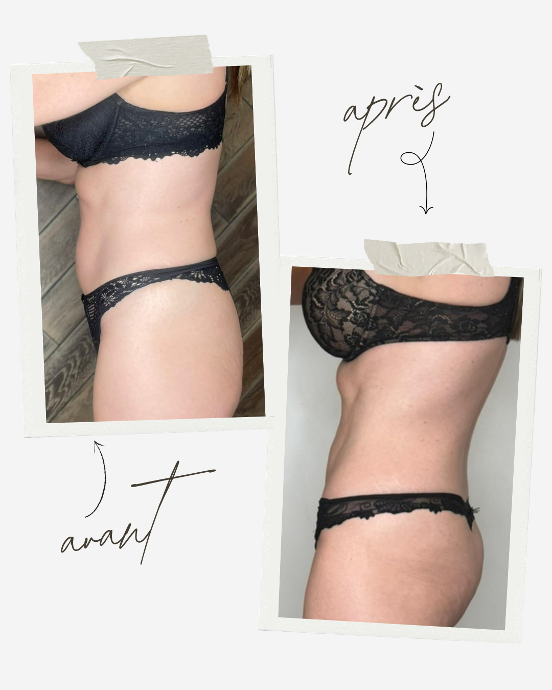 V-Core à Antibes : sculpter sa silhouette sans effort au Centre Thetys 1 résultats avant après V-Core 9 séances Centre Thetys Antibes silhouette sculptée