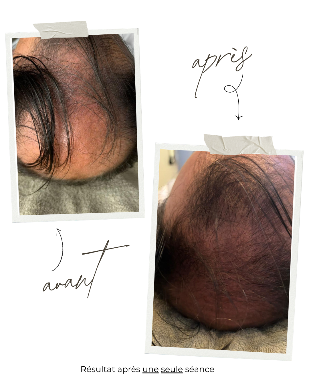 Avant après Microneedling Cheveux Mesoestetic au Centre Thetys, résultat après une seule séance