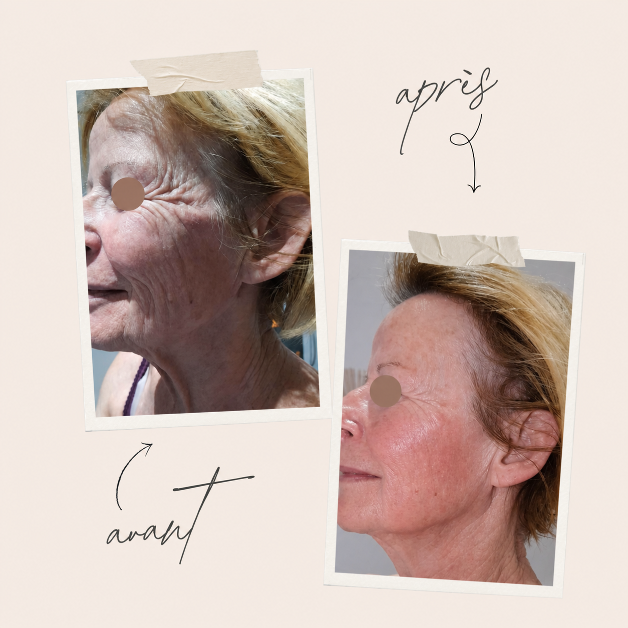 Résultats avant après HIFU lifting visage et cou au Centre Thetys Antibes