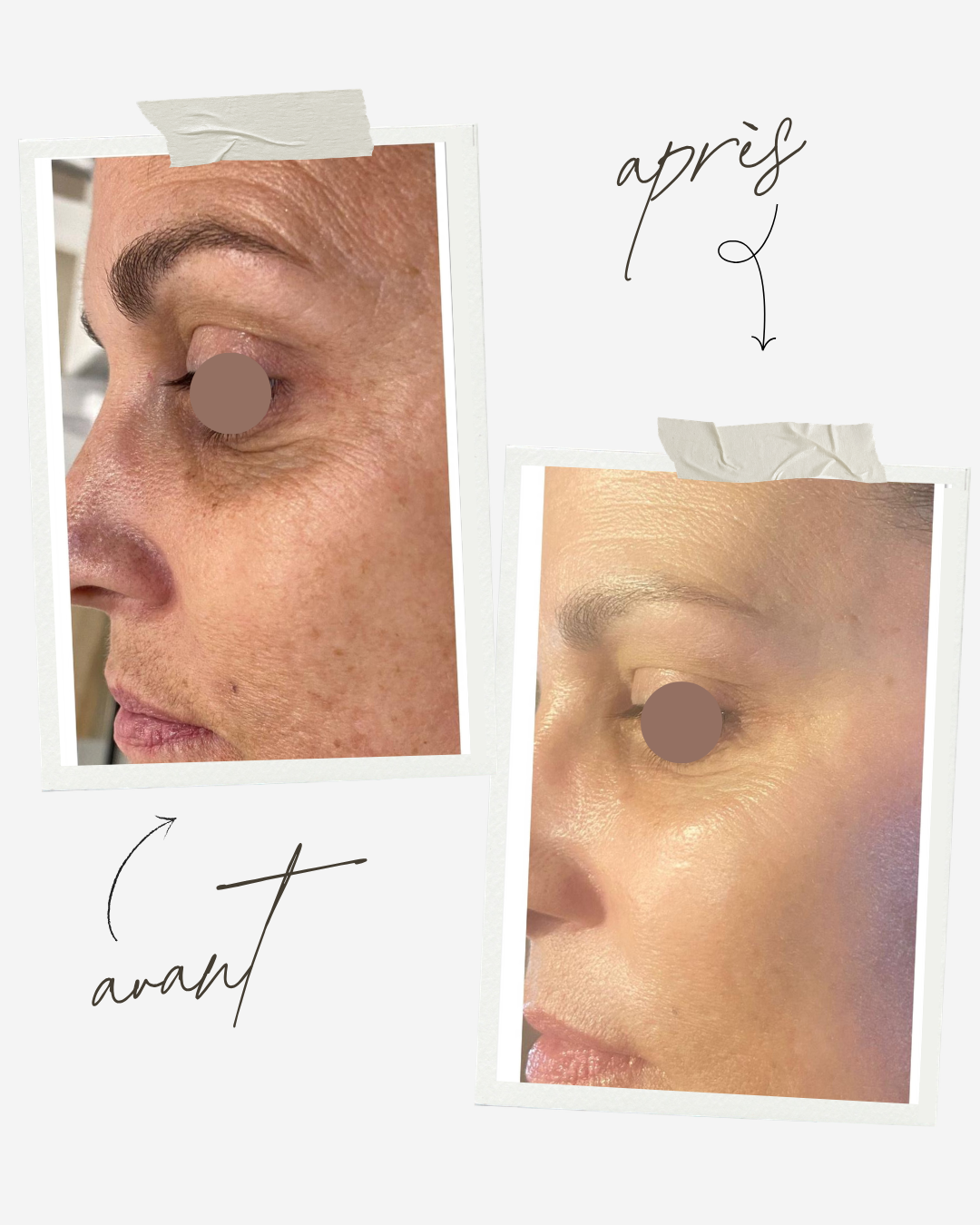 Résultats avant après microneedling Axion au Centre Thetys