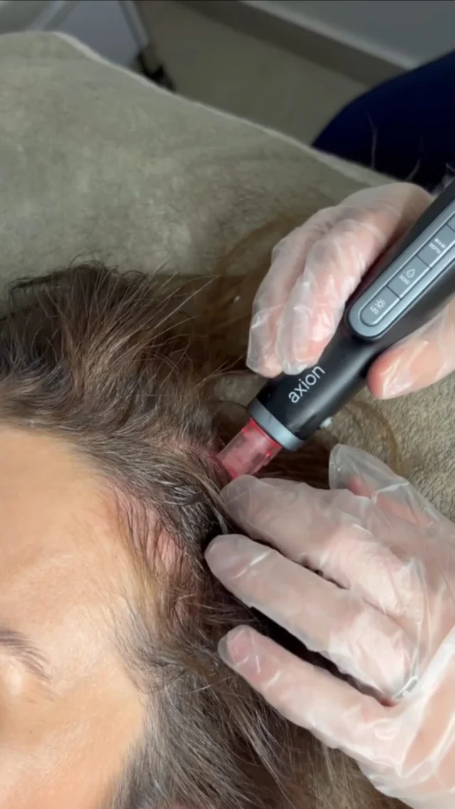 Soin Microneedling Cheveux au Centre Thetys, protocole Mesoestetic
