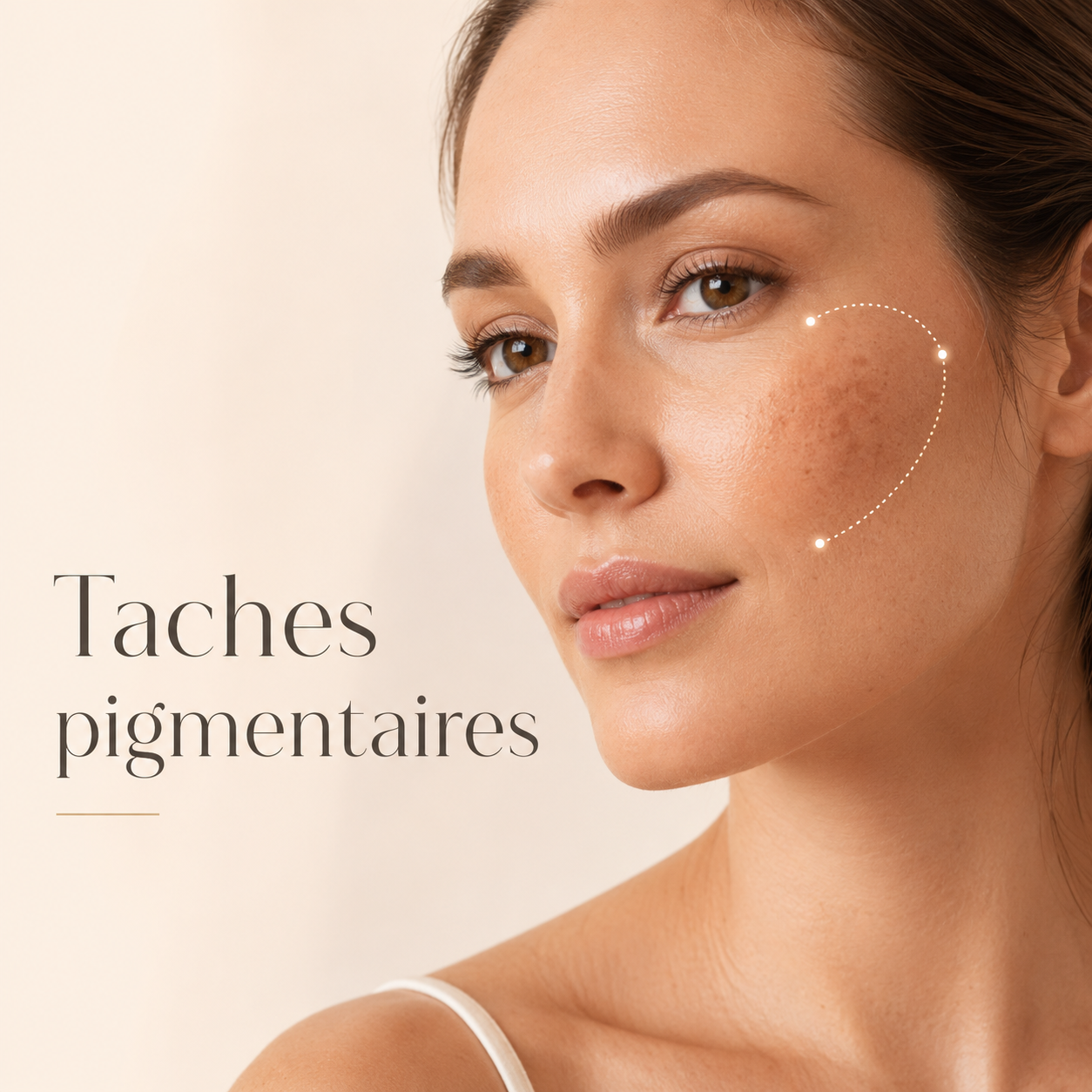 Microneedling Axion contre les taches pigmentaires au Centre Thetys