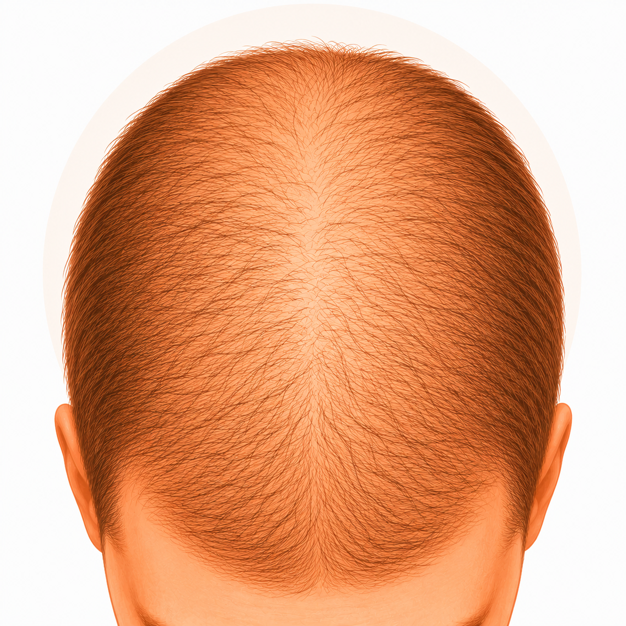 Microneedling capillaire : réveiller ses follicules et retrouver de la densité 5 Microneedling capillaire : chute diffuse