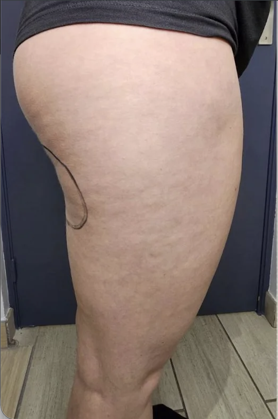 Jambes avant cryolipolyse au Centre Thetys Cannes