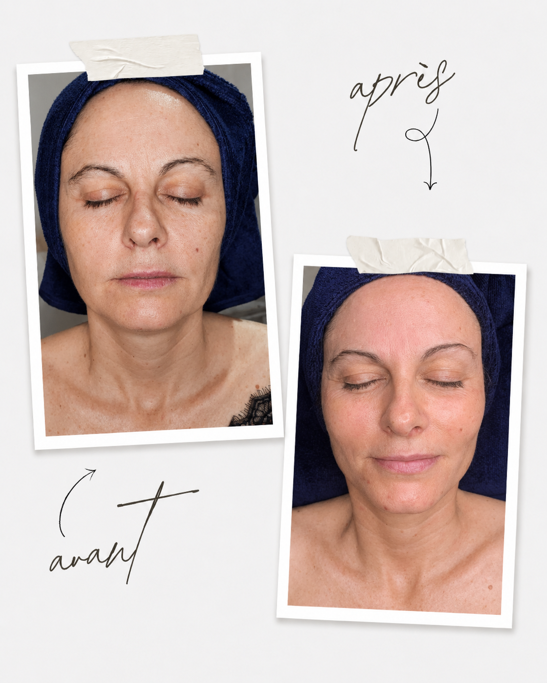 Avant apres soin visage Biologique Recherche au Centre Thetys