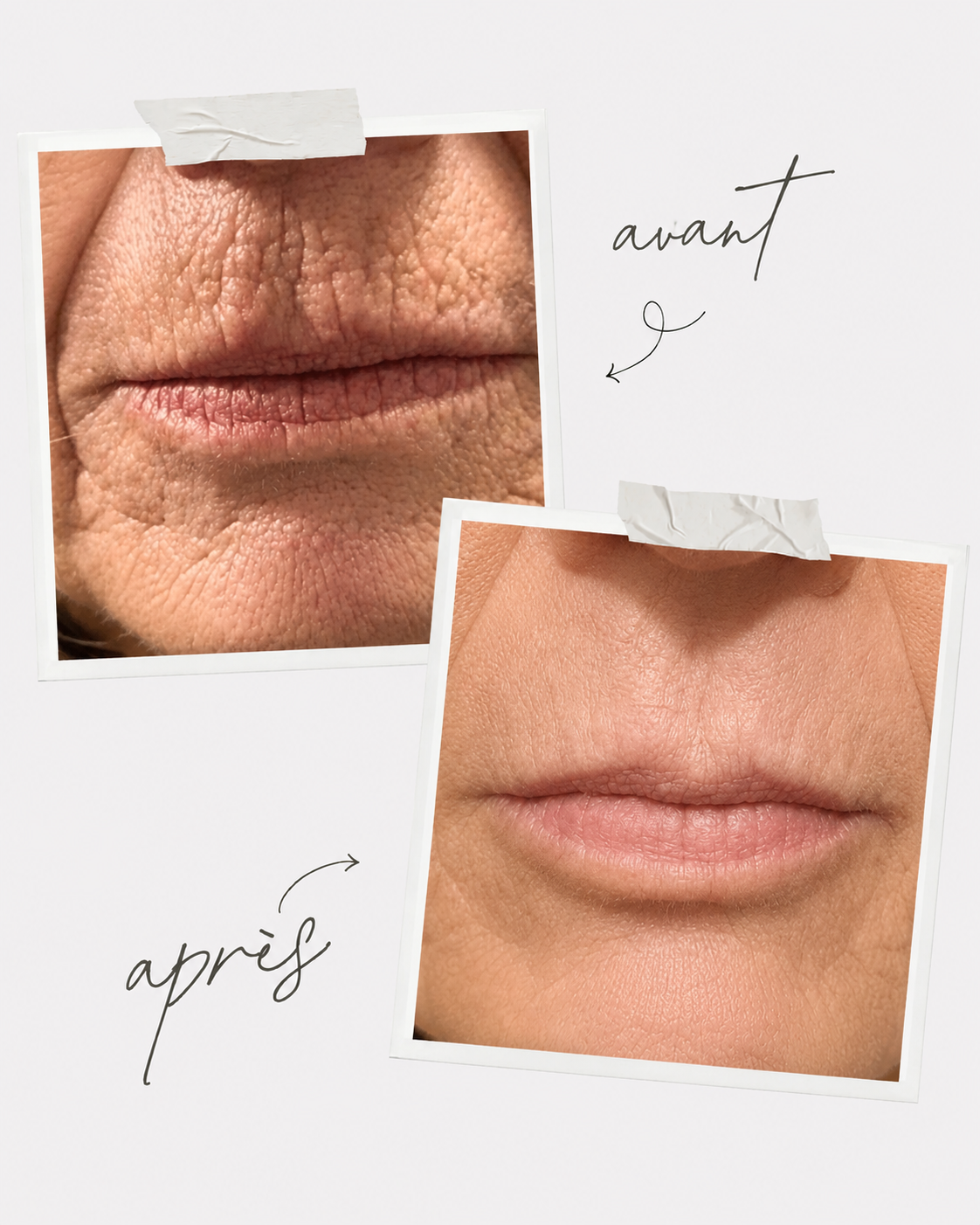 Résultat avant/après contour de bouche au Centre Thetys