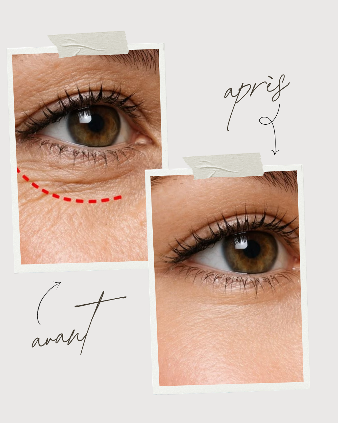 Avant après contour des yeux au Centre Thetys
