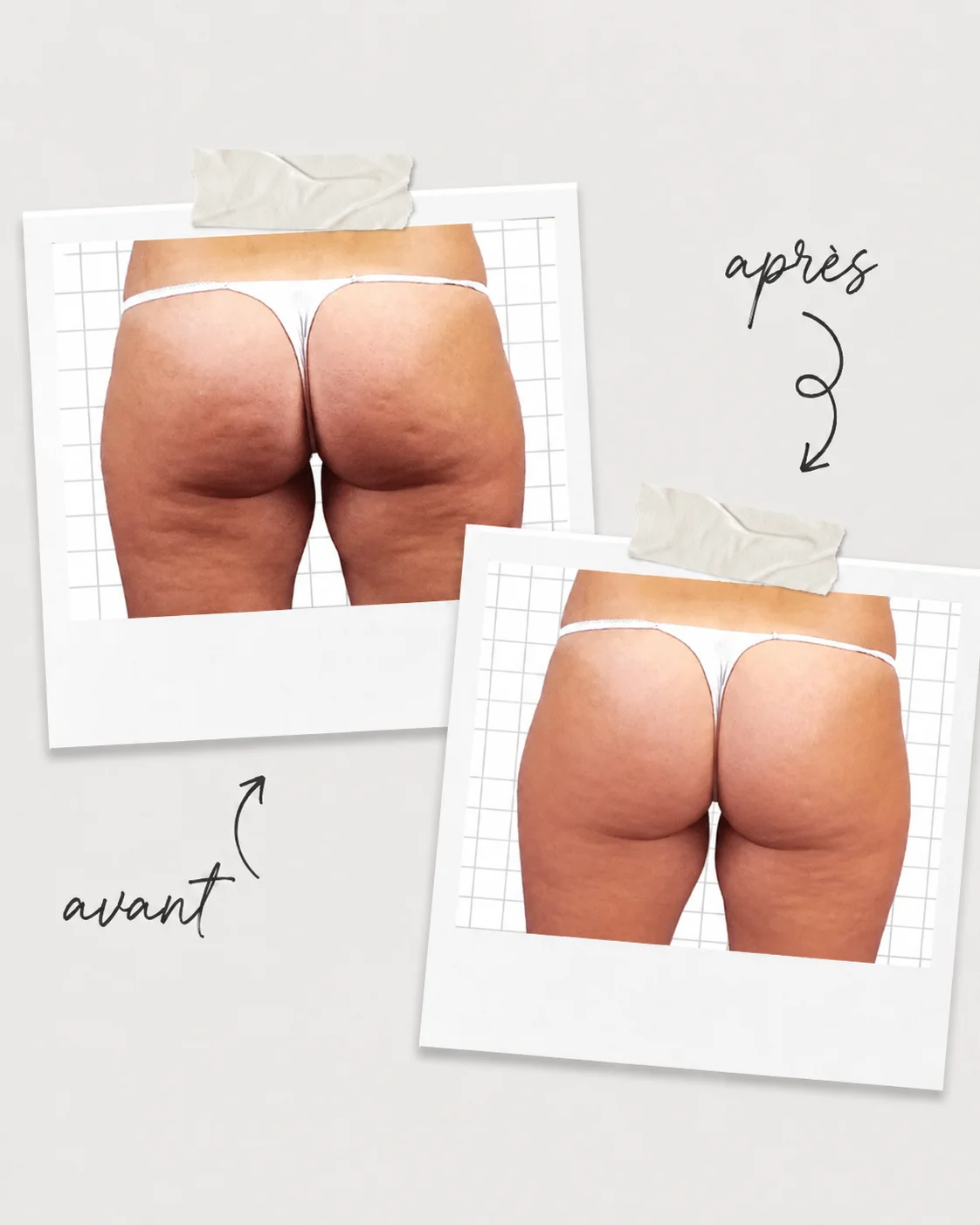 Avant après cellulite cure iCoone au Centre Thetys