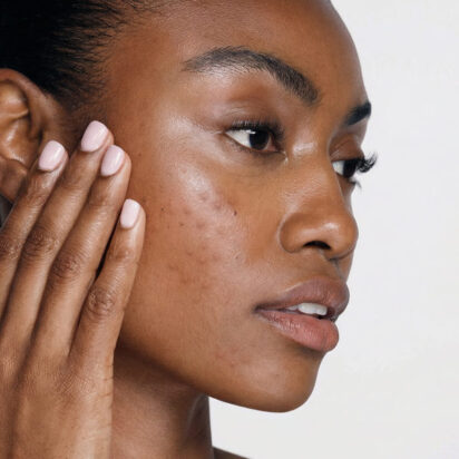 Cicatrices d'acné, pores dilatés et imperfections du visage
