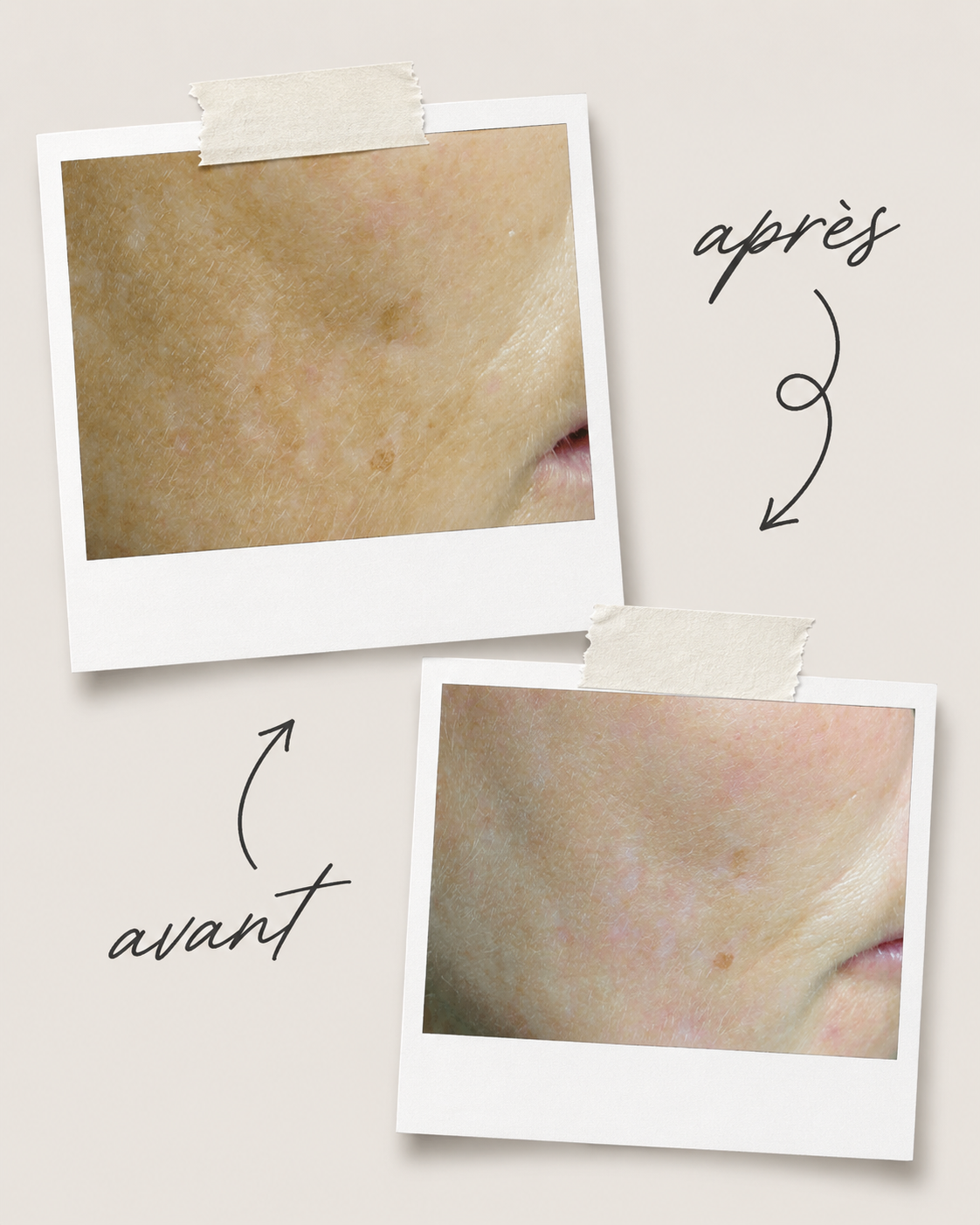 Avant apr&egrave;s peeling d&eacute;pigmentant Mesoestetic sur taches pigmentaires au Centre Thetys