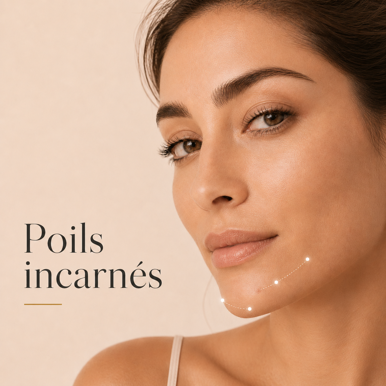Electrolyse, l'épilation définitive sans douleur 8 Traitement définitif des poils incarnés par électrolyse au Centre Thetys