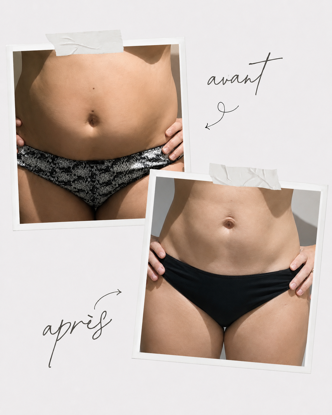 Je veux agir sur ma silhouette post-grossesse 2 Résultat avant/après silhouette post-grossesse au Centre Thetys