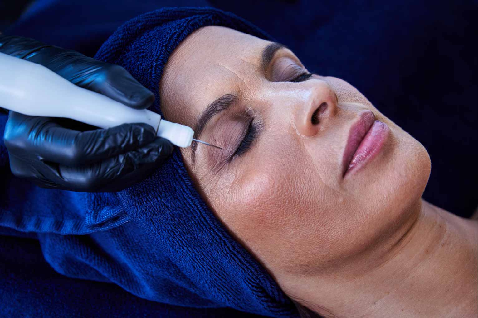 S&eacute;ance de Plasma Pulse sur le contour des yeux au Centre Thetys
