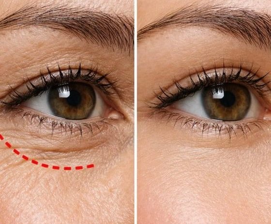 Avant après regard et contour des yeux au Centre Thetys