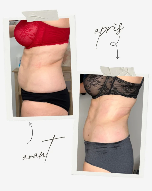 Des centimètres en moins… sans effort en plus 👙Et si c’était le bon moment pour passer à l’action, avec des résultats visibles, sans contrainte et sans solution invasive ? 🤩#minceur #objectifminceur #peauorange #cellulite