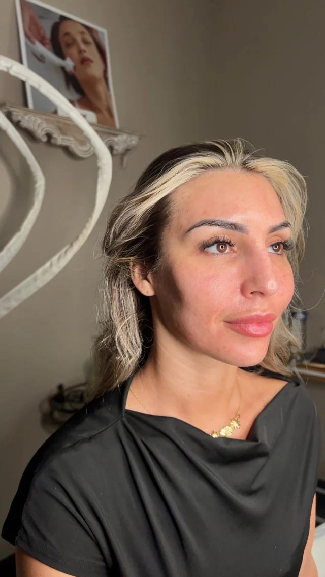 L’IA peut tout simuler… sauf ce glow-là. ✨#microneedling #glowyskin #trend #cannesfestival #soinvisage